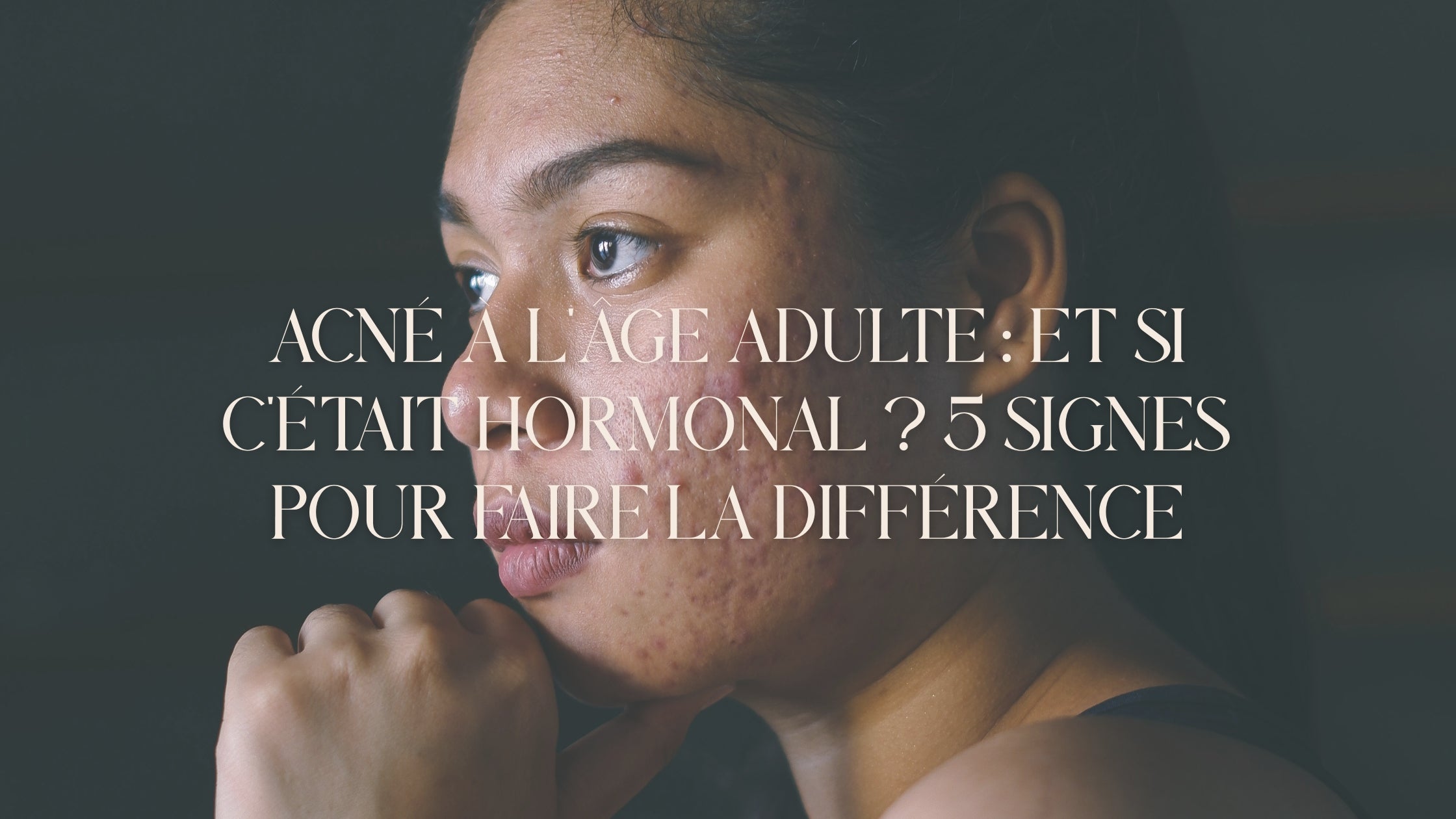 Acné à l'âge adulte : et si c'était hormonal ? 5 signes pour faire la différence