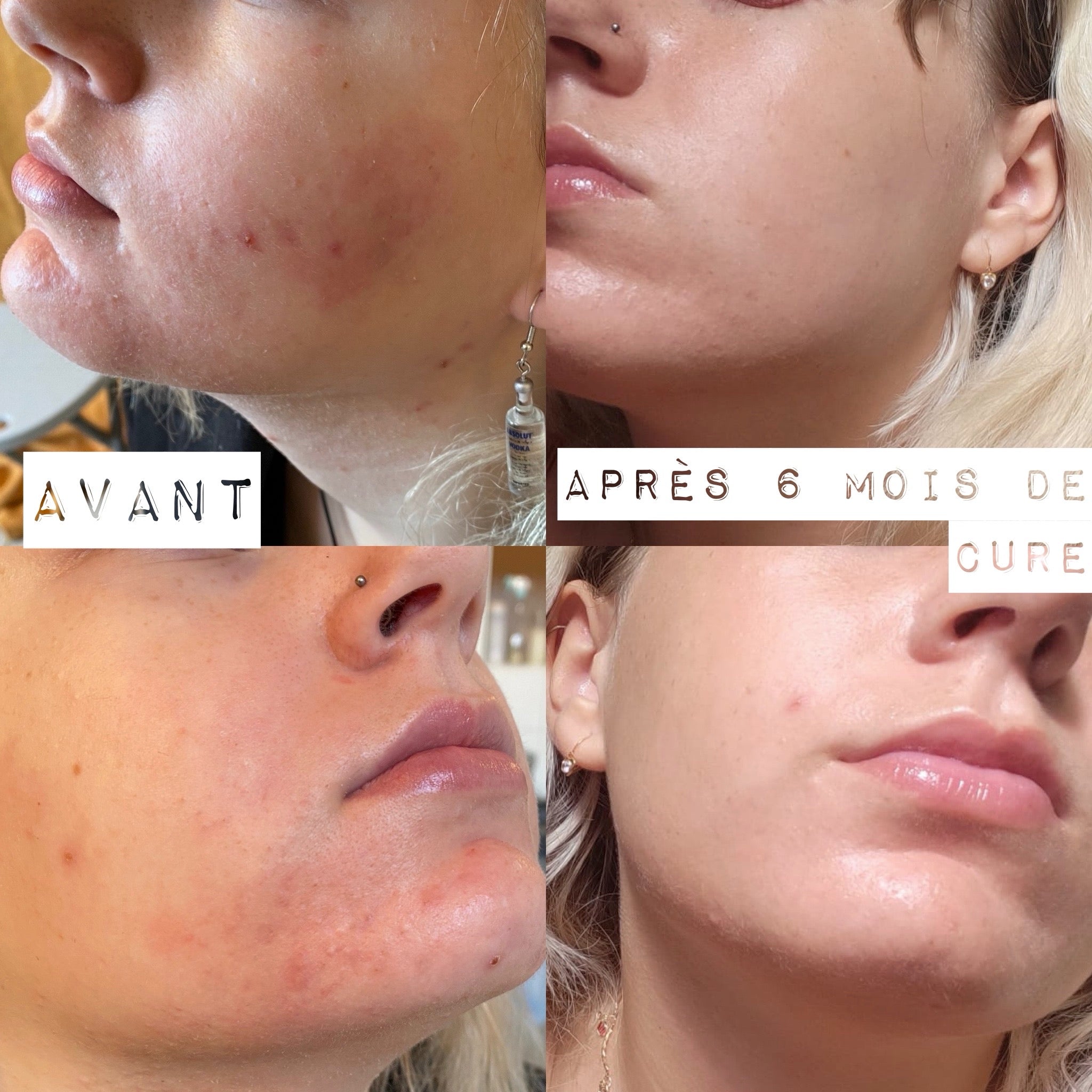 Elixir Peau Hormonale - Acné hormonale